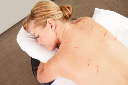 What is Acupuncture?